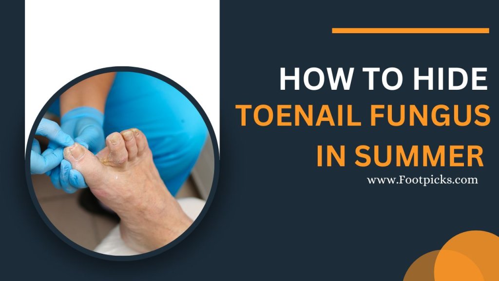 how-to-hide-toenail-fungus-in-the-summer-latest-info-2023